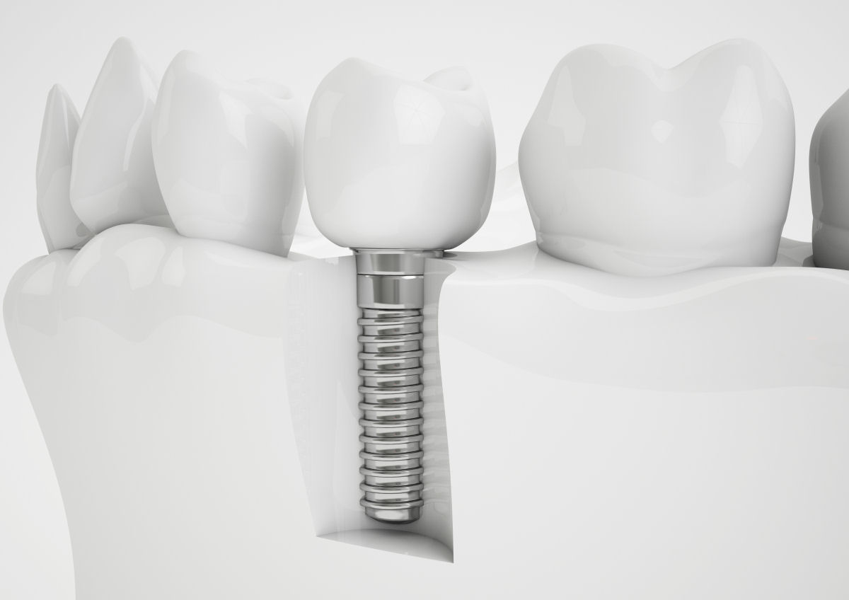 Implantologie - Besserer Halt durch künstliche Zahnwurzeln